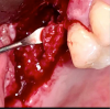 Fig 6. Intraoperative photograph showing re-entry to the maxillary sinus and removal of the non-consolidated bone graft material.