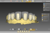 Fig 4. Tooth preparations and final design of the restorations in the initial software.