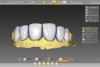 Fig 5. Final design of the restorations in place on the intraoral scan.