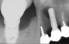 Fig 1. Crestal (left) versus apical (right) peri-implantitis.