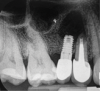 Fig 3. Intraoperative radiograph demonstrating apical resection of implant and tooth.