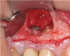 Fig 4. Intraoperative situation after apical resection of implant and tooth.