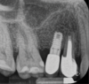 Fig 5. Postoperative radiograph showing defect ossification after 4 months.