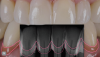 Fig 5. Superimposed over the photograph, a radiograph of the patient's anterior teeth show existing bone loss.