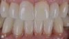 Fig 6. Patient Cody's anterior teeth one year post-treatment.