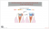 Fig 12. Giomers offer sustainable fluoride release and recharge.