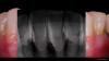 Fig 14. Radiograph and photograph reveal the results of treatment.