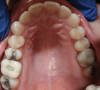 Fig 2. Occlusal view highlighting the erosive wear present on the lingual aspects of the maxillary anterior teeth with a preserved enamel ring around the gingival margin.