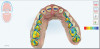 Fig 6. Scan of preparations with iTero Occlusogram activated. This feature shows occlusal clearance and occlusal contacts using a gradient feature and graphic key. This allows a clinician to quickly know if enough clearance has been achieved for fabrication of restorations.