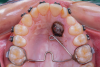 Fig 5. Open exposure of a palatal impacted canine. A transpalatal bar was used as an anchorage source with an extension arm designed for direct traction.