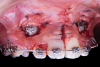 Fig 6. Use of apically positioned flap to manage bilateral facially impacted canines. During the same procedure a midline frenectomy was performed after the exposure and bilateral brackets were placed (Fig 6). Orthodontic traction was performed, which allowed both canines to be properly placed in the upper arch (Fig 7).