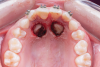 Fig 8. Open exposure (Fig 8) with spontaneous eruption for 7 months. Once the canines reached the occlusal plane, buccal traction was performed for an additional 5 months. Total treatment time to move the bilateral palatal impacted canines into the arch was 12 months (Fig 9).