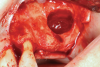 Fig 2. Lateral sinus augmentation at maxillary left quadrant after lateral window preparation and Schneiderian membrane elevation.