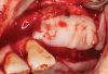 Fig 7. L-PRF membrane used as an adjunct during tissue closure after lateral sinus augmentation.