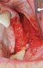 Fig 9. Atrophic maxillary left quadrant ridge prior to ridge augmentation.
