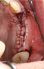 Fig 13. Flap closure and suturing after graft and membrane placement at maxillary left quadrant.