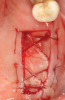 Fig 16. In a separate case, prepared L-PRF for use as a biologic bandage at palatal donor site after FGG harvest is shown (Fig 15); intraoperative photograph (Fig 16) shows L-PRF membrane sutured at palatal wound site after FGG harvest for postoperative pain control.