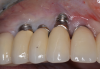 Fig 1. Demonstration of buccal soft-tissue recession in the esthetic zone. Together with a high lip line, this can cause a significant esthetic problem.