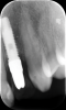 Fig 3. Placement of an implant in a young adult. A female patient had had a congenitally missing maxillary lateral incisor restored when she was 20 years old. Ten years later (Fig 2) the implant-supported restoration was in an infraocclusion state, shorter than the neighboring teeth, due to continuous skeletal growth. Radiograph (Fig 3) showed the marginal bone level of the implant was not affected.