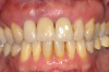 Fig 4. Skeletal growth can affect the esthetic zone at any age. A 35-year-old woman with a missing central incisor (No. 8) due to trauma was restored with an implant. Ten years later, as shown, a small discrepancy between the occlusal planes of the two central incisors due to continued skeletal growth can be noticed.