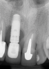 Fig 6. A 35-year-old patient with a missing central incisor due to trauma was restored with an implant (Fig 5, day of second-stage surgery). Twelve years later she presented to the office complaining that pus was draining from the implant and she felt uncomfortable. As can be seen in Fig 6, severe peri-implant bone loss due to peri-implantitis was evident.