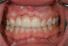 Fig 6. Gingival-colored porcelain was used to restore an implant site where fractured maxillary anterior teeth Nos. 7 and 8 remained too long. Although the result was functionally successful, it was considered an esthetic compromise.