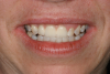 Fig 7. The gingival-colored porcelain was slightly visible upon smiling. This patient’s high smile line should have been the determining factor in the decision to restore or extract.