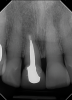 Fig 10. A 24-year follow-up radiograph of an endodontically treated tooth, with a cast post-and-core and adequate tooth structure remaining. The patient had a low smile line and thick phenotype.
