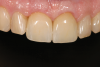 Fig 13. Successful final restoration of implant No. 8. Had the clinician waited too long to extract the failing endodontically treated tooth No. 8, the result may have been compromised, especially if the patient had a high smile line.