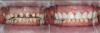 Fig 7. Crown preparations and chairside provisional restorations.