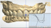 Fig 8. Lab modifications while fabricating polymethylmethacrylate provisional crowns.