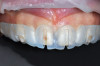 Fig 11. 3D printed reduction guide and gingivectomy guide.