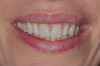 Fig 12. Final lithium disilicate veneers.