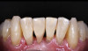 Fig 14. Final lithium disilicate resin-bonded bridge.