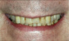 Fig 15. Initial presentation for patient with attrition, discolored teeth, and defective restorations.
