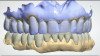Fig 18. Virtual wax-up design (white) overlayed onto scan of existing teeth (blue).