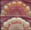 21. 3D-printed temporary shells being tried in after crown preparation prior to relining.