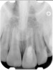 Fig 8. 3-year follow-up showing continued root development.