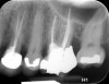 Fig 13. 2-year follow-up radiographs showing the positive outcome.