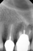 Fig 20. 6-month follow-up radiograph.