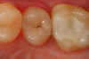 Fig 1. A preoperative occlusal view of tooth No. 13 that has a “stain” in the occlusal groove that does not “stick” with an explorer.