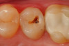 Fig 2. After a fissurotomy bur is used to conservatively open into the groove, a rather extensive carious area is discovered.