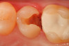 Fig 4. After removal of the infected dentin, a diode laser (GeminiTM, Ultradent Products) is used to remove the interproximal gingival tissue next to the cavity margin to facilitate placement of the matrix and sealing of the gingival margin.