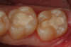 Fig 11. The preparation on tooth No. 19 is disinfected with 2% chlorhexidine solution (ConsepsisTM, Ultradent Products) after the bleeding site was controlled with a diode laser. A bioactive cavity liner (TheraCalTM LC, Bisco Dental Products) was then placed over the exposure and light cured. Next, a bioactive “dentin replacement” material (TheraBase®, Bisco Dental Products)  was used to base both cavity preparations to a more ideal depth just apical to the dentinoenamel junction.