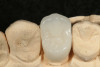 Fig 15. An occlusal view of an all-ceramic crown (IPS e.max, Ivoclar Vivadent) for tooth No. 13.