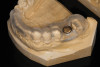 CAD/CAM-milled surgical guide designed from CAD data and CBCT implant plan for guided implant placement.