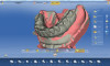 CAD/CAM scan of wax-up prosthesis on master implant model.