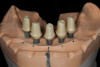 Laboratory-based CAD/CAM-milled telescopic abutments seated on master implant model.