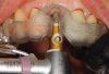 Fig 1. 3D-printed surgical guide for drill control position and depth.