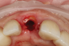 Fig 4. In partial extraction therapy, intentional
sectioning of a root leaves a fragment attached to the facial aspect to
preserve hard and soft tissue. An implant can be placed simultaneously
or in a delayed approach.